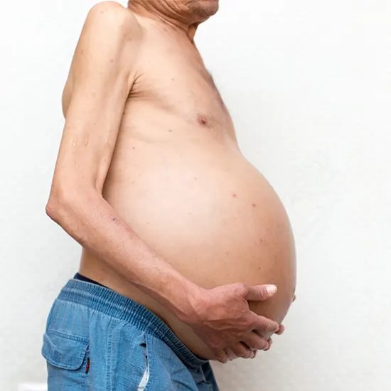 Ascites Treatment
